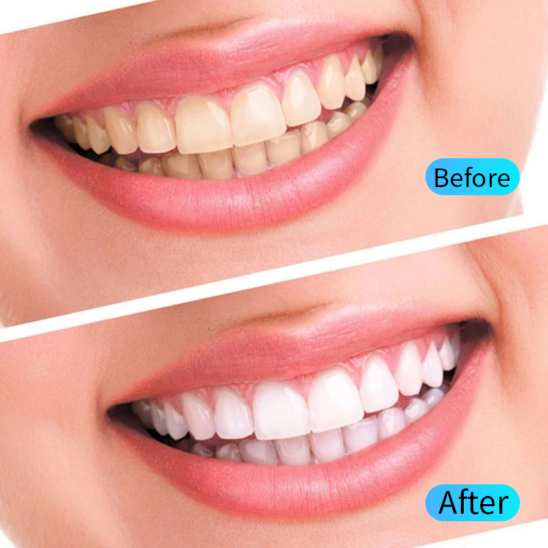Kit de Gel de blanchiment des  - Teeth Whitening Opalescence avis et prix