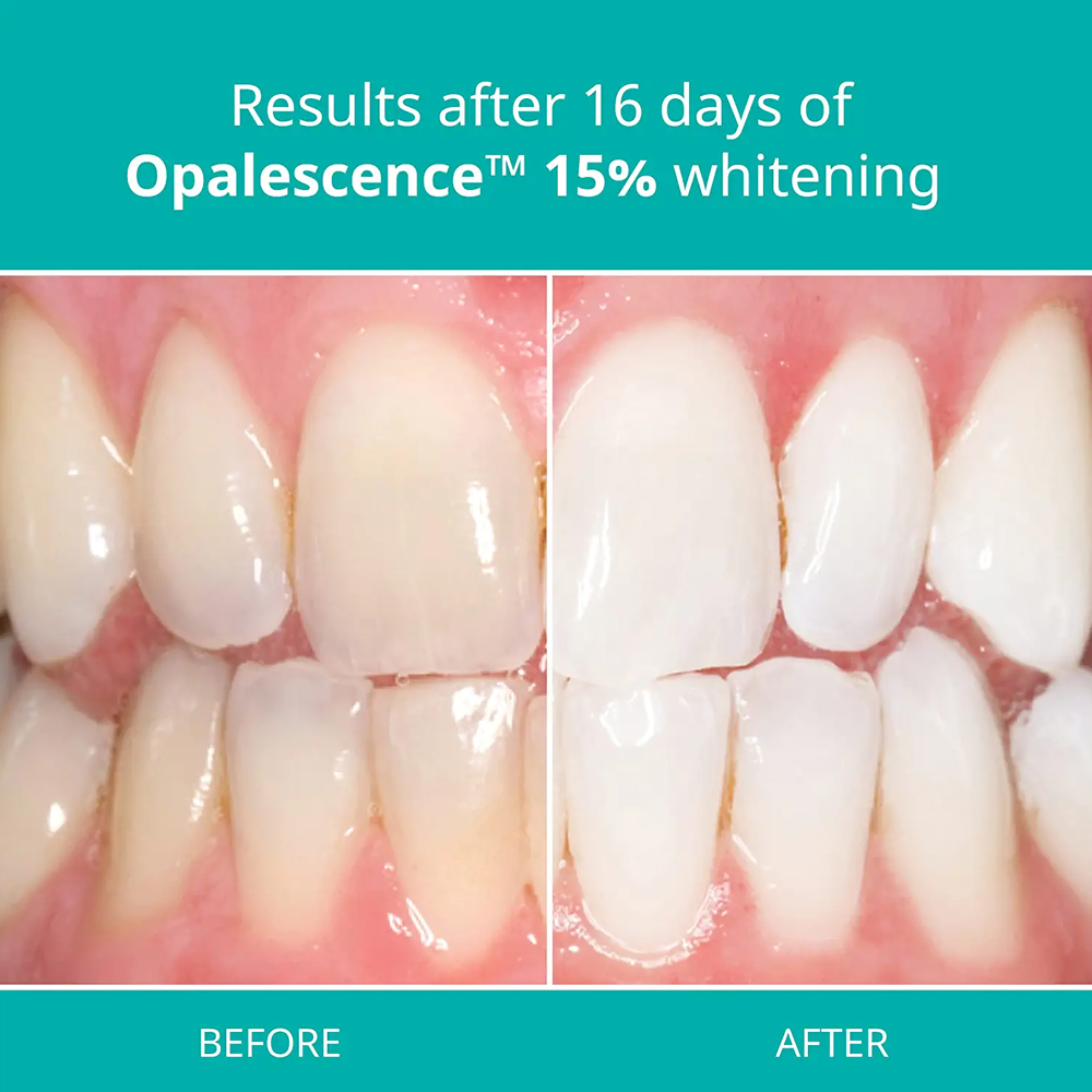 Kit de blanchiment professionn - Teeth Whitening Opalescence avis et prix