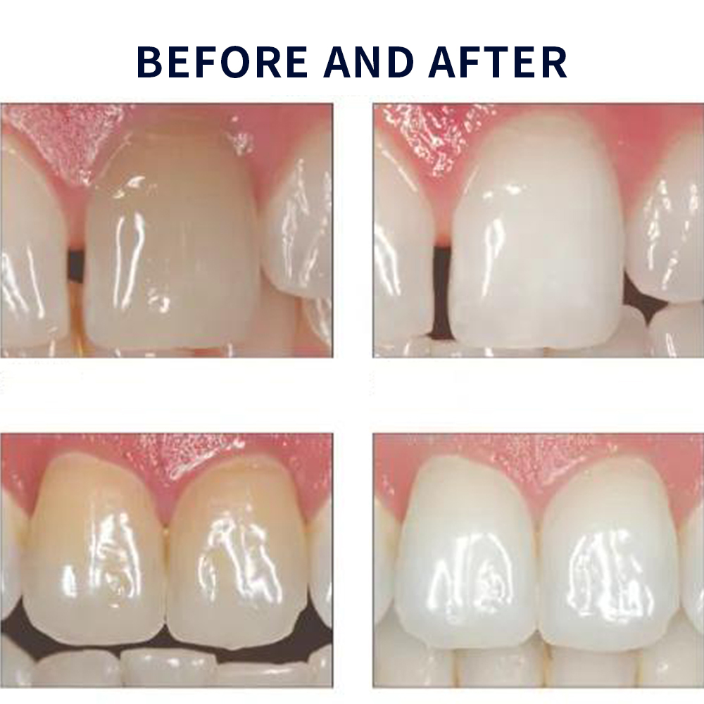 Opalwisdom-Kit de Blanchiment  - Teeth Whitening Opalescence avis et prix