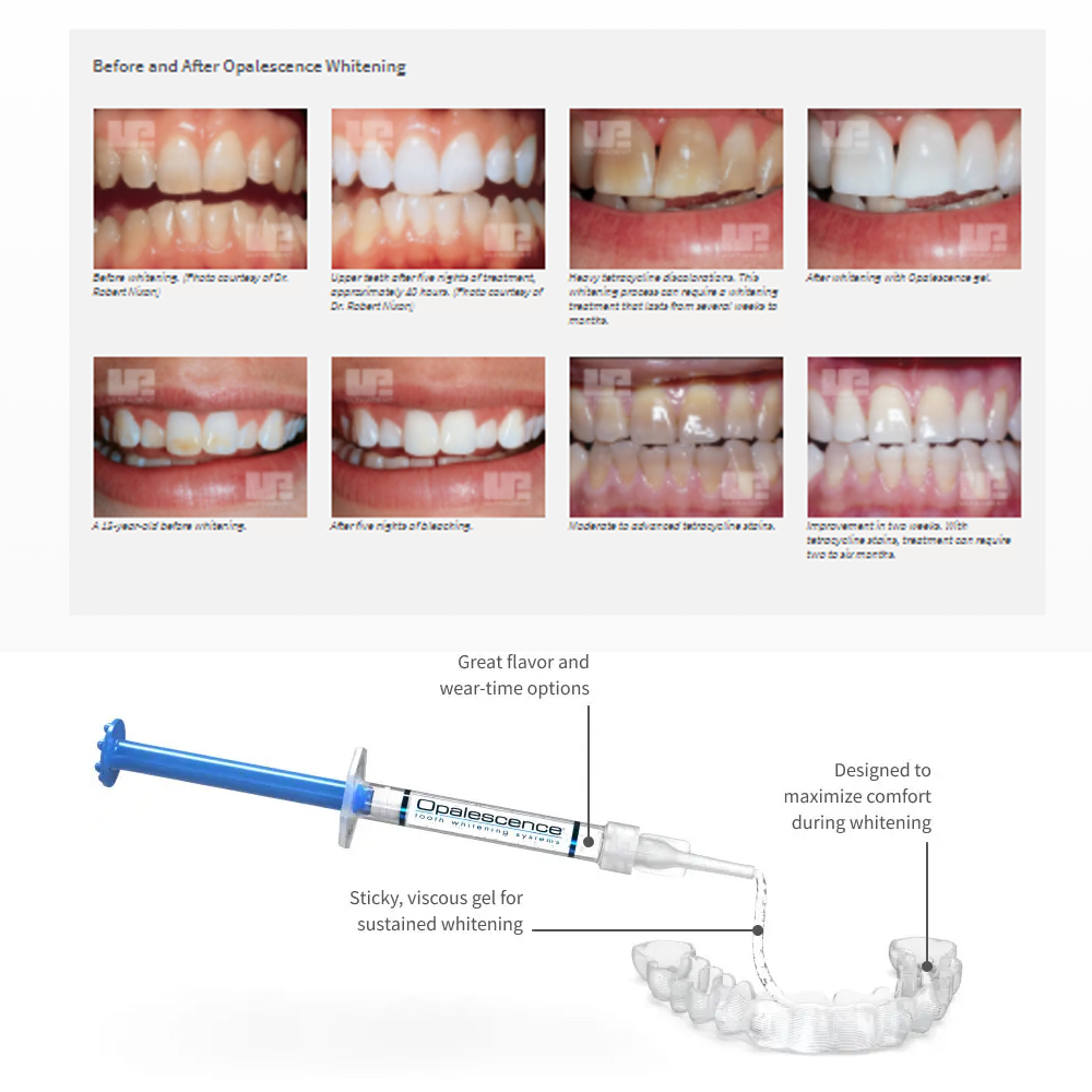 Opalwisdom-Kit de Blanchiment  - Teeth Whitening Opalescence avis et prix
