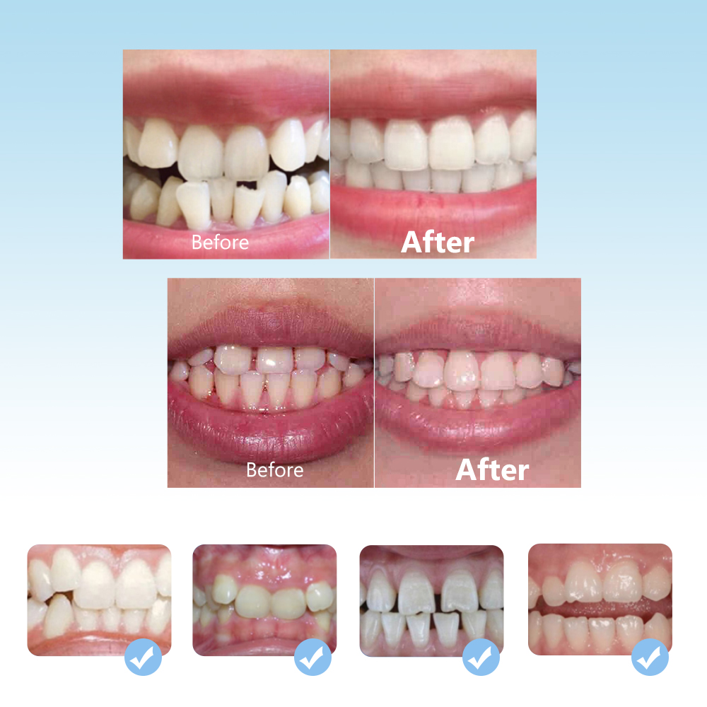 Ensemble de bretelles orthodon - Teeth Whitening Retainer avis et prix