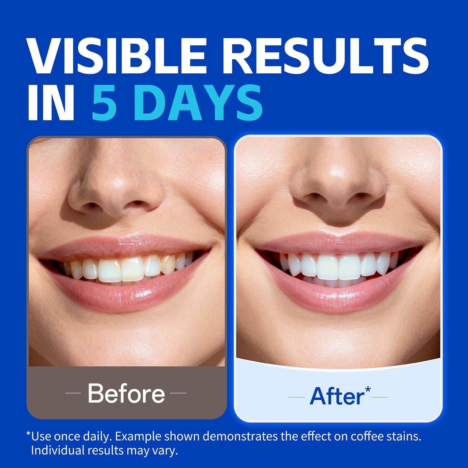 1/7 paires de bandes blanchiss - Teeth Whitening Retainer avis et prix