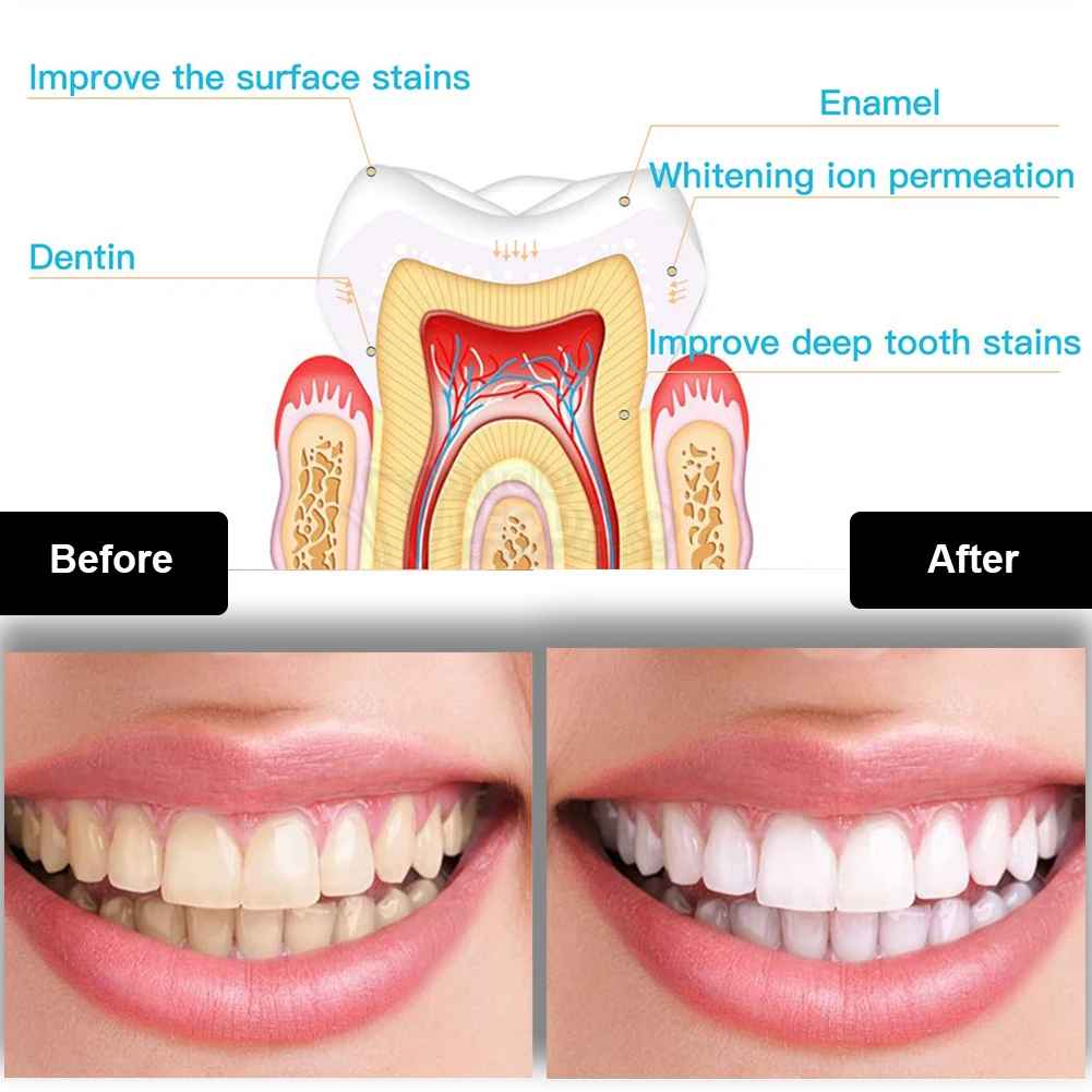 Kit de blanchiment des dents d - Teeth Whitening Opalescence avis et prix